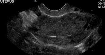 trv ultrasound image of IUD