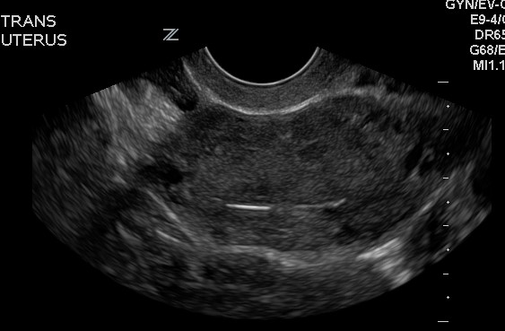trv ultrasound image of IUD
