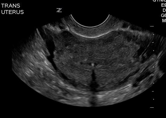 Confirming IUD Placement • Sonosession